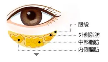 眼袋