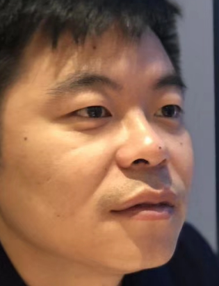 去眼袋手术