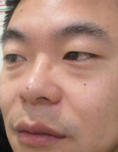 去眼袋手术
