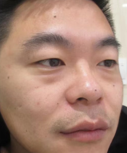 去眼袋手术