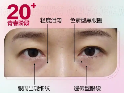 眼袋