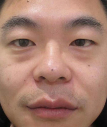 去眼袋手术