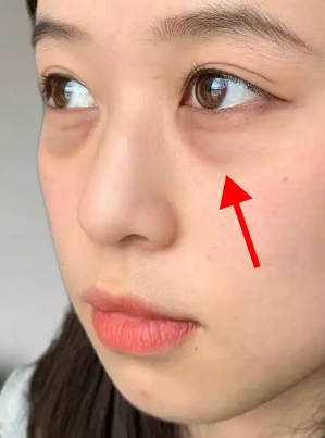 去眼袋手术