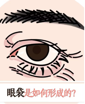 去眼袋手术