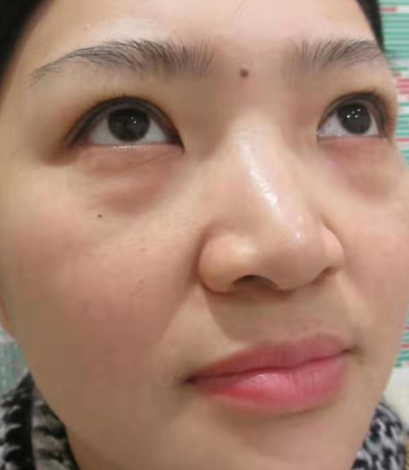 去眼袋手术