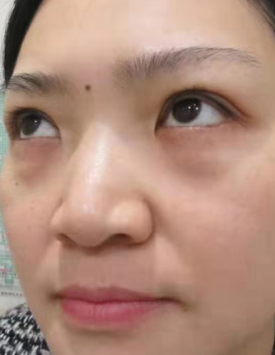 去眼袋手术