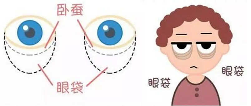 去眼袋手术