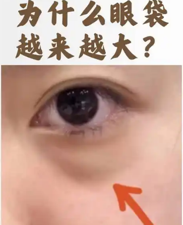去眼袋手术