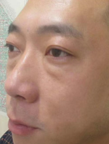 去眼袋手术