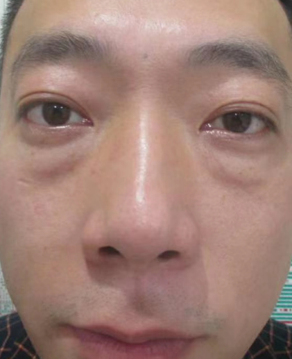 去眼袋手术