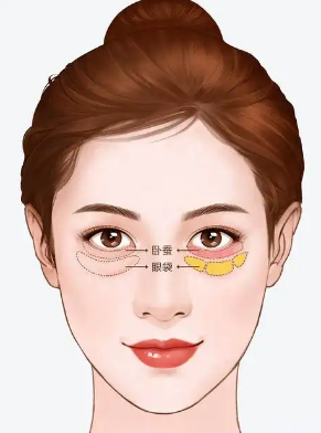 去眼袋手术