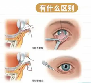 去眼袋手术