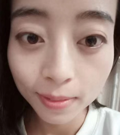去眼袋手术