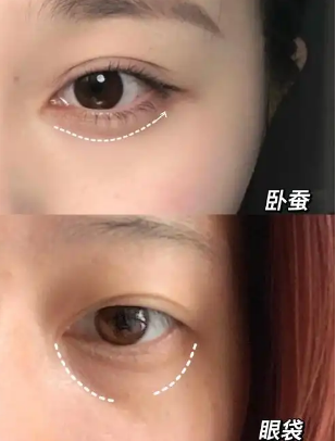 去眼袋手术