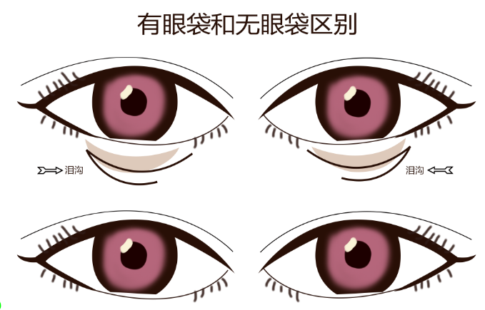 去眼袋手术