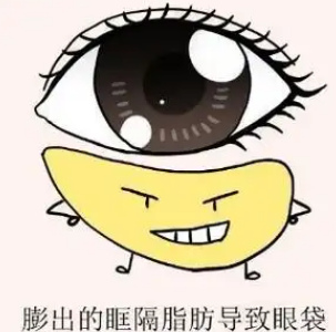 去眼袋手术