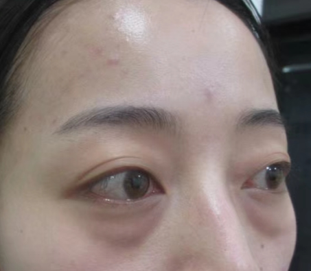 去眼袋手术