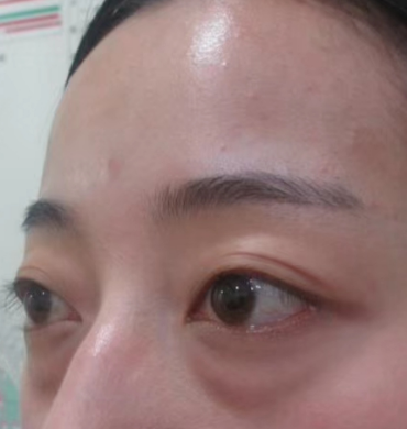 去眼袋手术