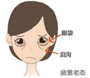 去眼袋手术