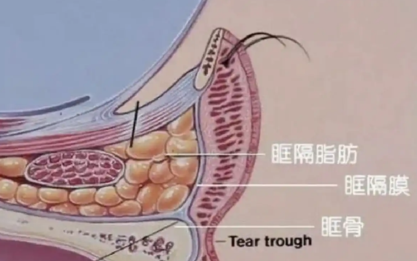 去眼袋手术
