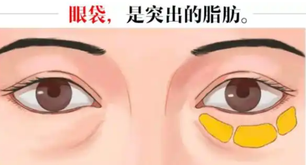 去眼袋手术