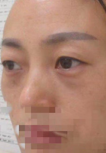 去眼袋手术