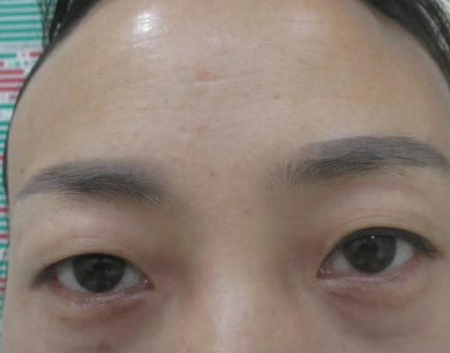 去眼袋手术