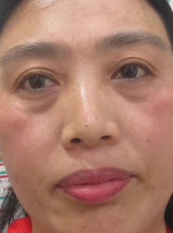 去眼袋手术