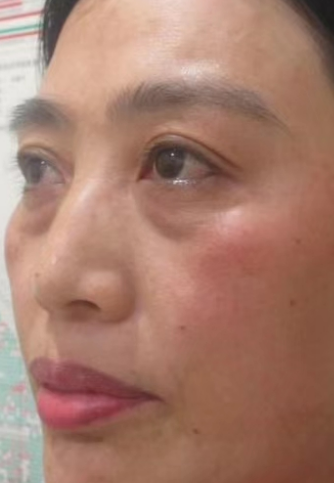 去眼袋手术