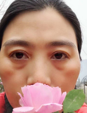 去眼袋手术