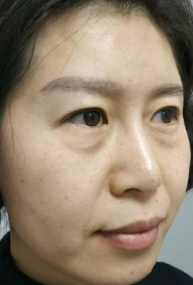 去眼袋手术