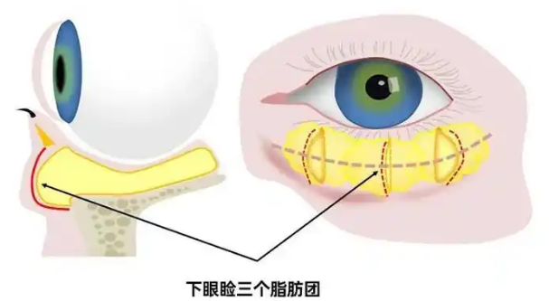 去眼袋手术