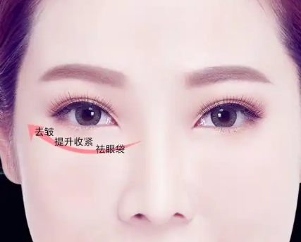 去眼袋手术