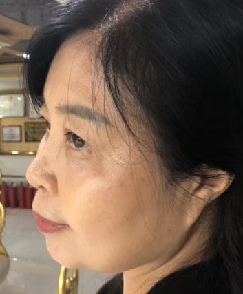 去眼袋手术