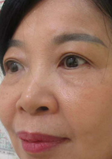 去眼袋手术
