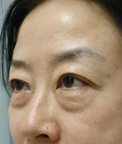 去眼袋手术