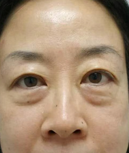 去眼袋手术