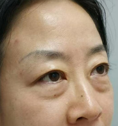 去眼袋手术