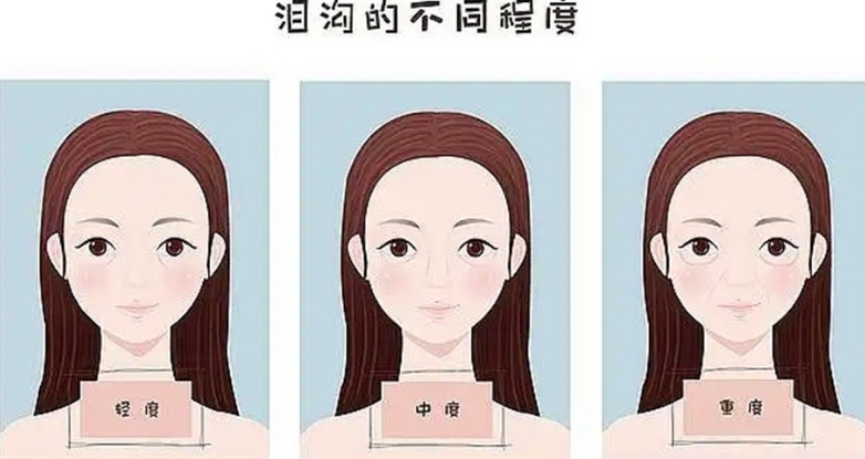 泪沟
