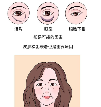 去眼袋手术
