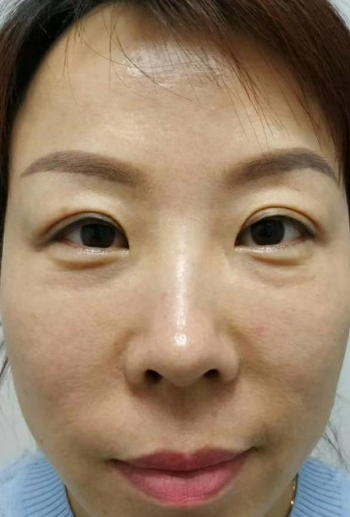 去眼袋手术