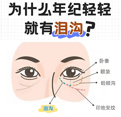 泪沟
