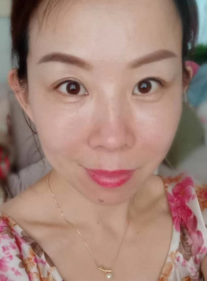 去眼袋手术