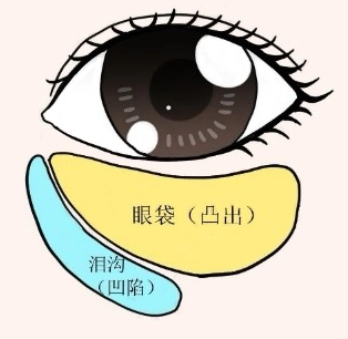 去眼袋手术