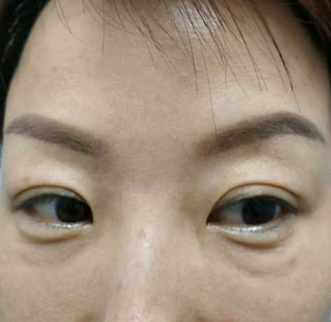 去眼袋手术