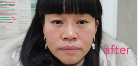 去眼袋手术