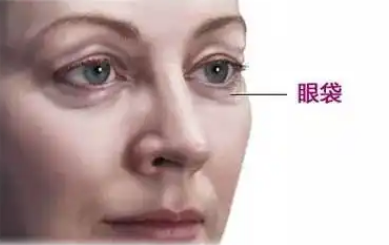 去眼袋手术