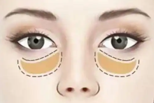 眼袋