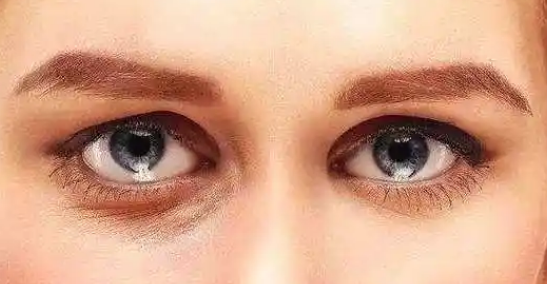 眼袋