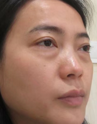 去眼袋手术